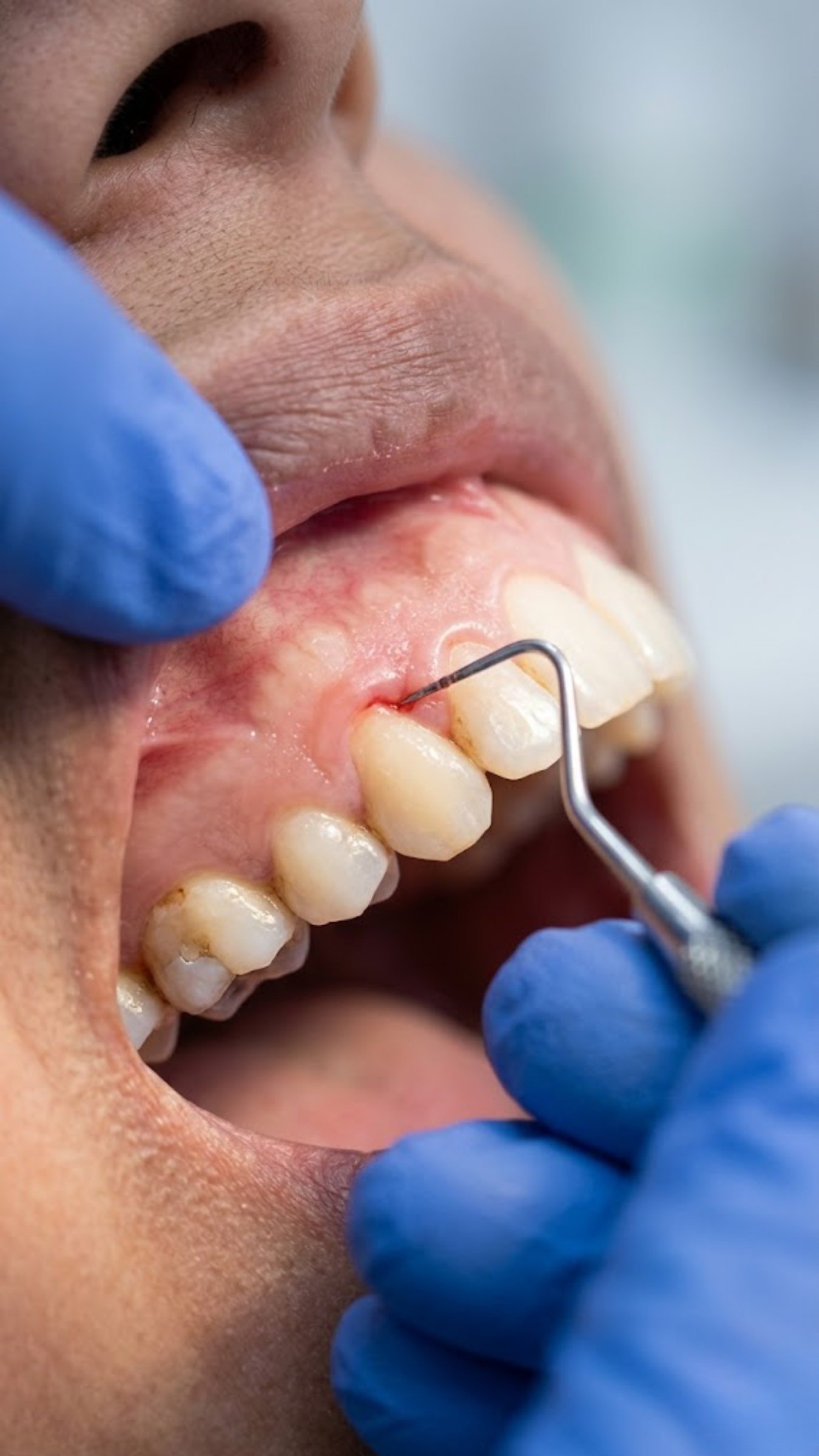 Advanced Gum Treatments